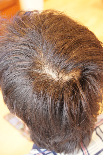 ハゲ 予防,つむじ はげ,若ハゲ,はげ 遺伝,生え際,はげ 髪型,禿げ,はげ 原因,はげ防止 
