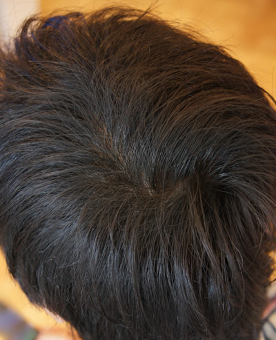 ハゲ 予防,つむじ はげ,若ハゲ,はげ 遺伝,生え際,はげ 髪型,禿げ,はげ 原因,はげ防止