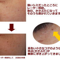 神戸「Qスイッチ レーザーシミ取り」レポート②「びとう皮膚科」クリニックで、女子力アップ！