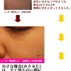 神戸「 レーザー シミ取り」レポート③シミレーザー治療経過は「びとう皮膚科」クリニックで。
